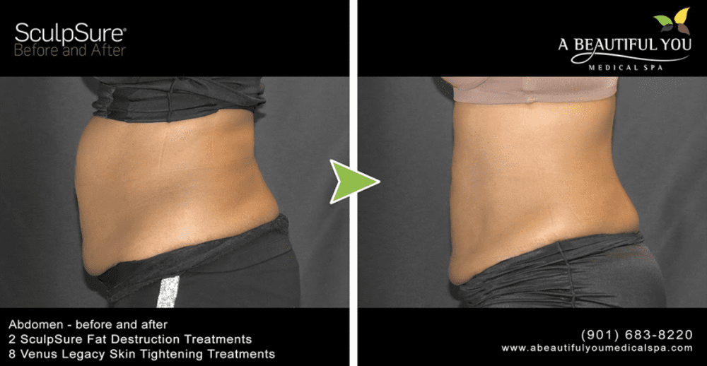 Finish Off Your Weight Loss Journey With Body Contouring - A Beautiful You  Medical Spa