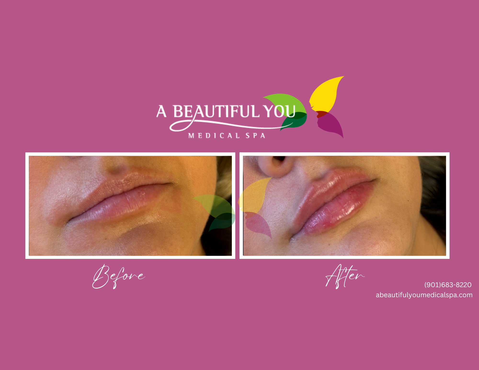 Dermal Filler