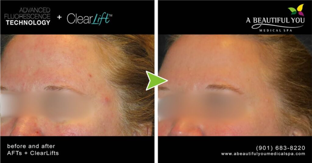 AFT + ClearLift A Beautiful You Medical Spa Tones Tightens