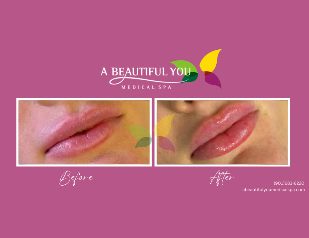 Dermal Filler