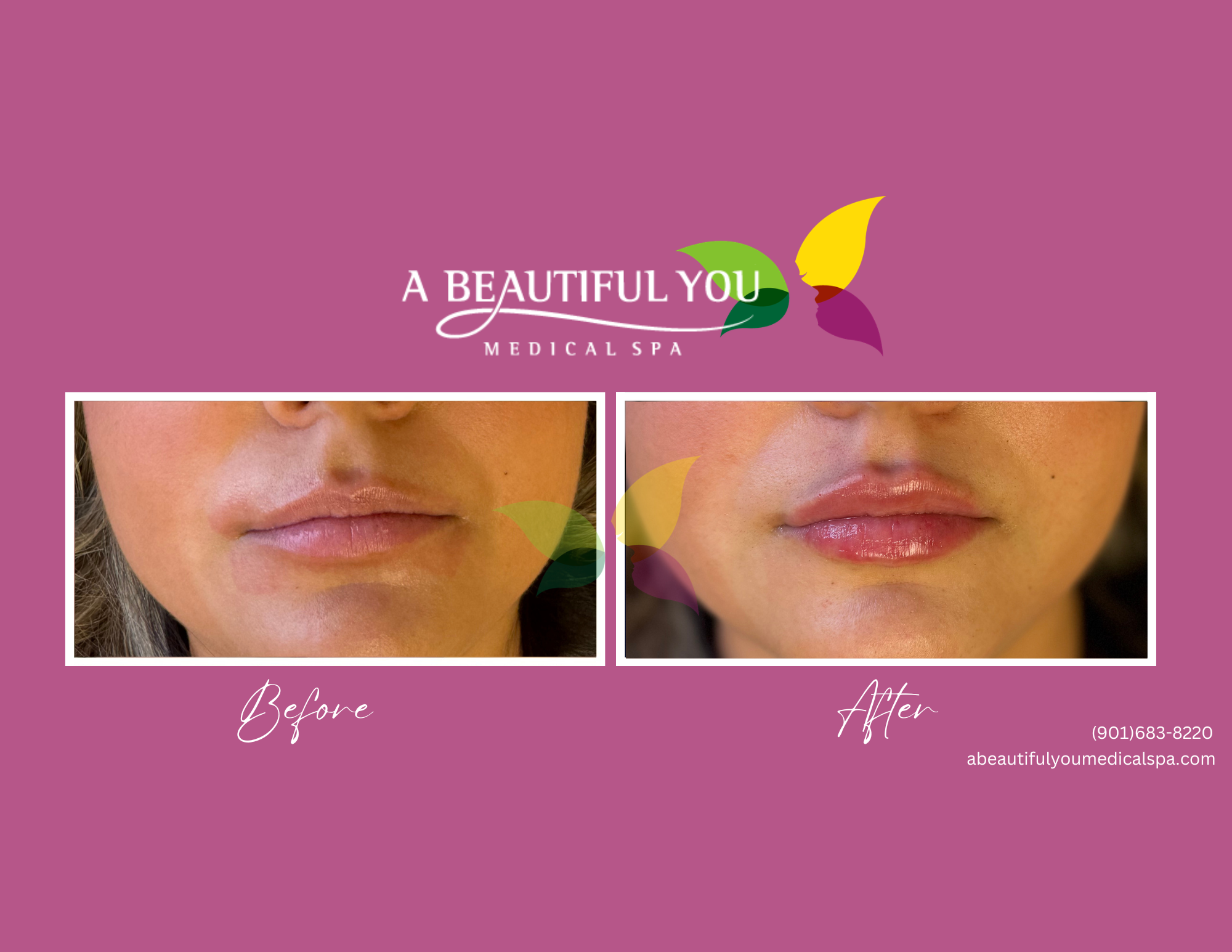 Dermal Filler