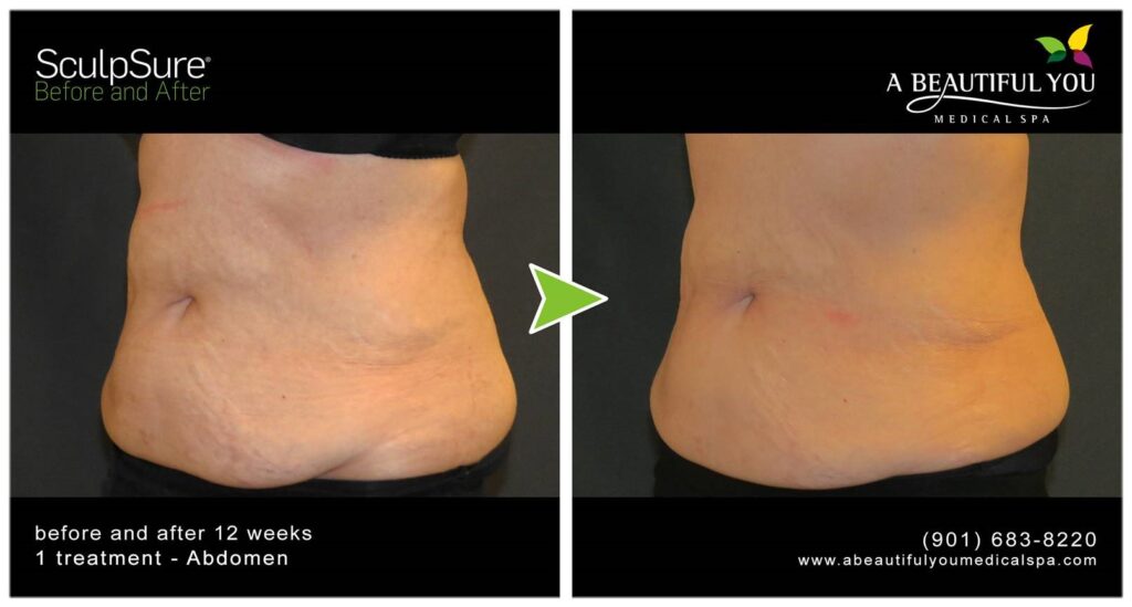 SculpSure Body Contouring A Beautiful You Medical Spa