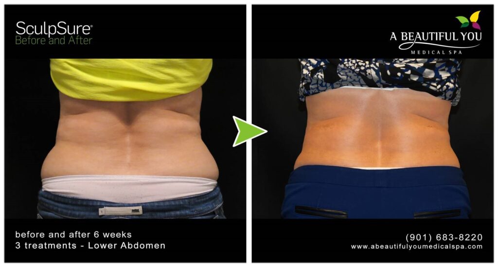 SculpSure Body Contouring A Beautiful You Medical Spa