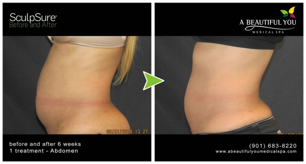SculpSure Body Contouring A Beautiful You Medical Spa