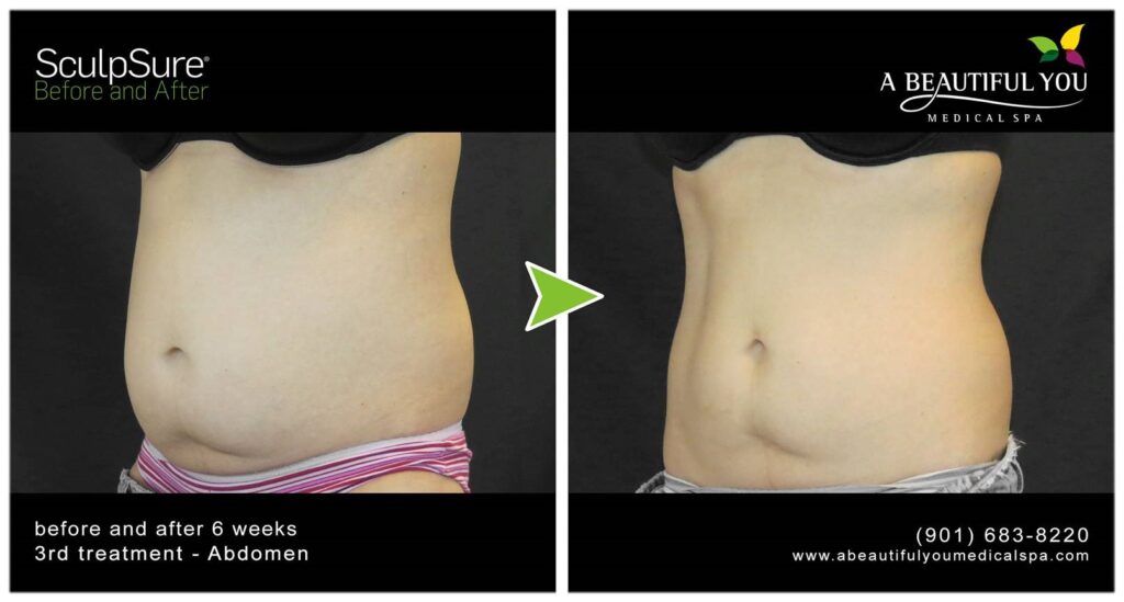 SculpSure Body Contouring A Beautiful You Medical Spa