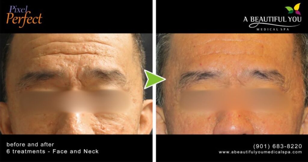 Pixel Skin Resurfacing A Beautiful You Medical Spa