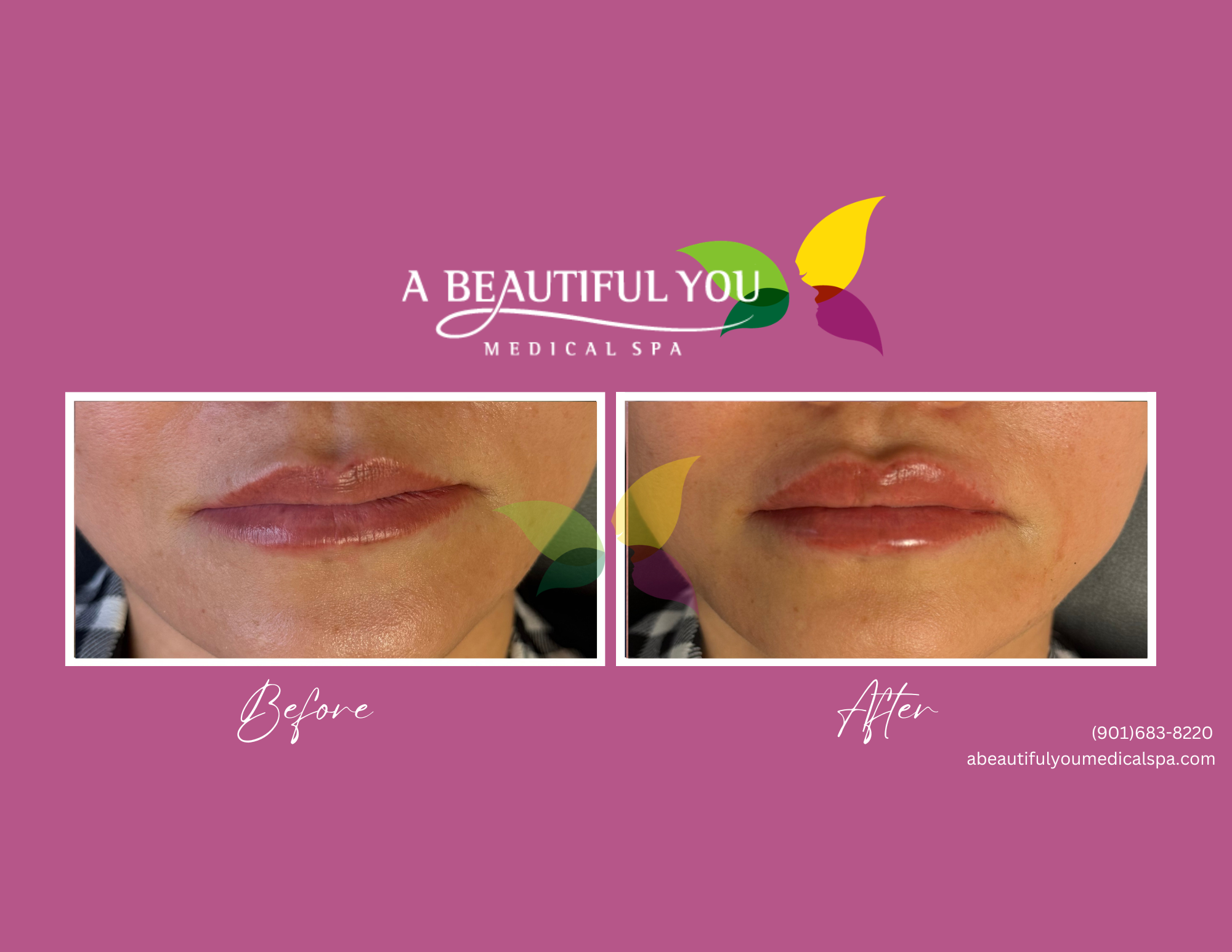 Dermal Filler