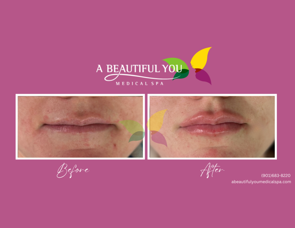 Dermal Filler