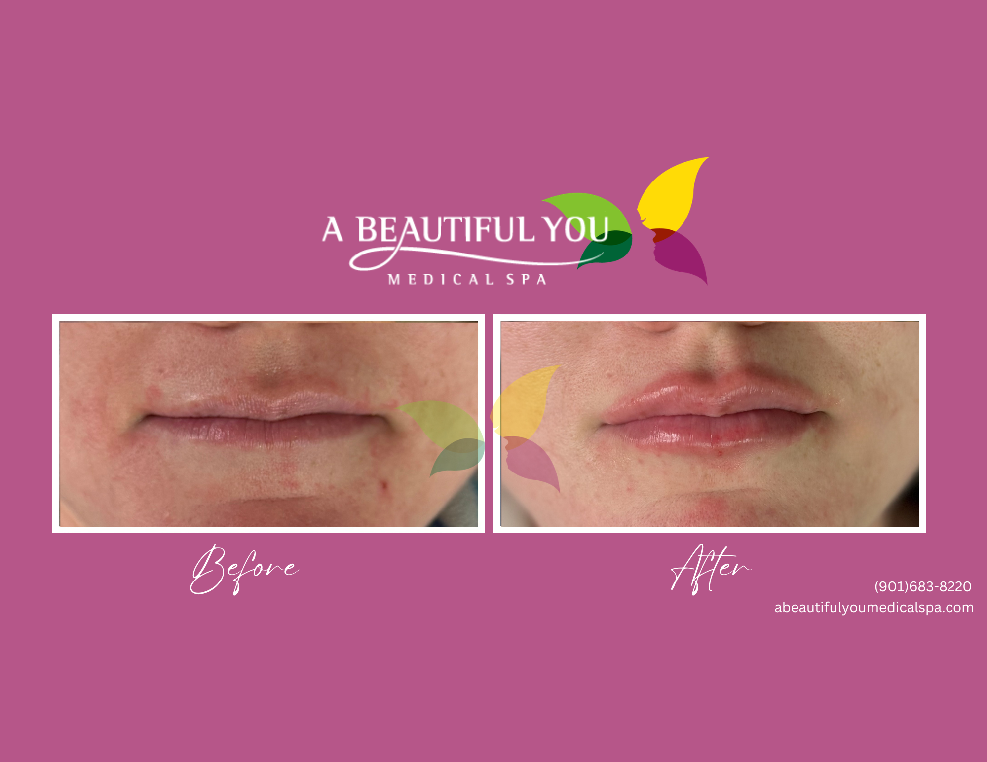 Dermal Filler