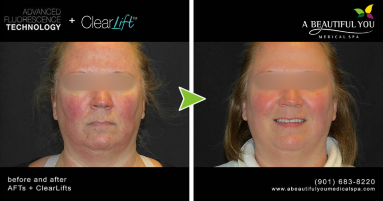 AFT + ClearLift A Beautiful You Medical Spa Tones Tightens