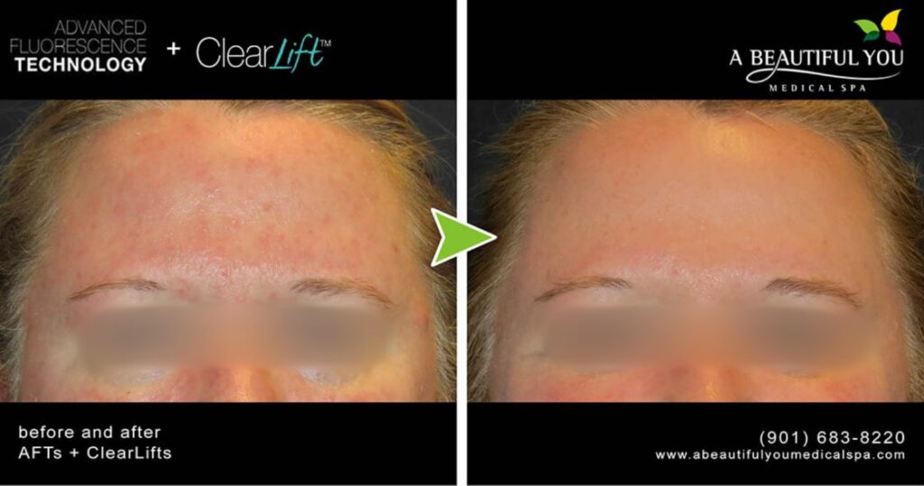 AFT + ClearLift A Beautiful You Medical Spa Tones Tightens