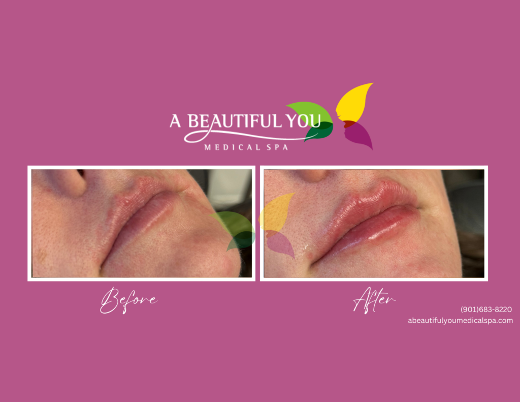 Dermal Filler