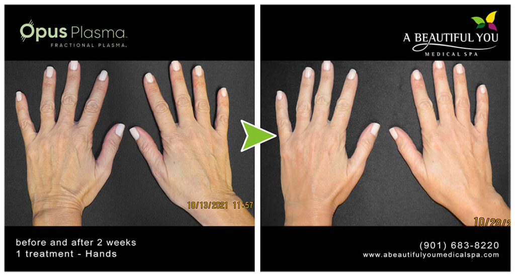 Opus Plasma Hands