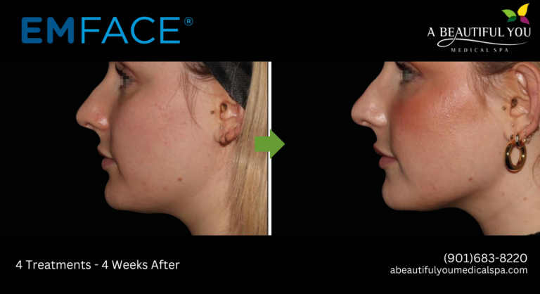 A Beautiful You Medical Spa EMFACE Lift