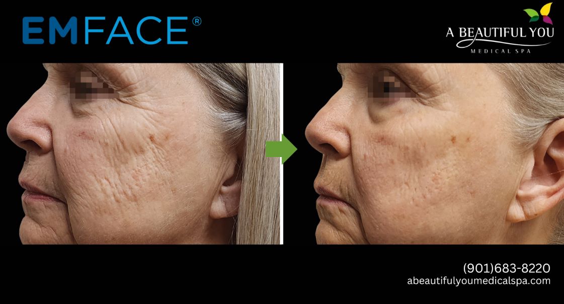 A Beautiful You Medical Spa EMFACE Lift