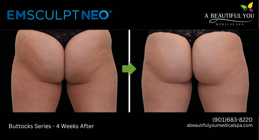 EMSCULPT - Neo Fat Destruction A Beautiful You Medical Spa
