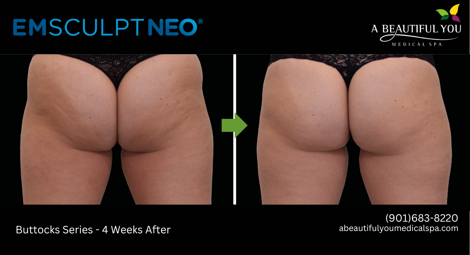 EMSCULPT - Neo Fat Destruction A Beautiful You Medical Spa