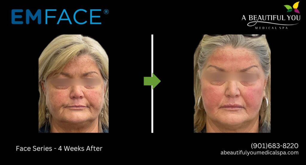 A Beautiful You Medical Spa EMFACE Lift