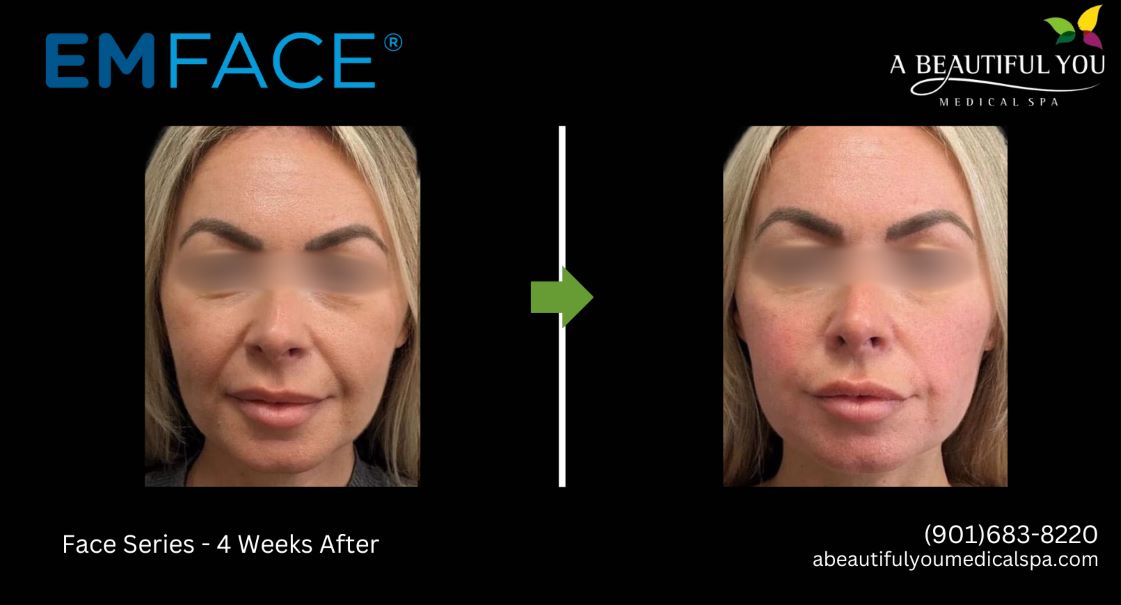 A Beautiful You Medical Spa EMFACE Lift