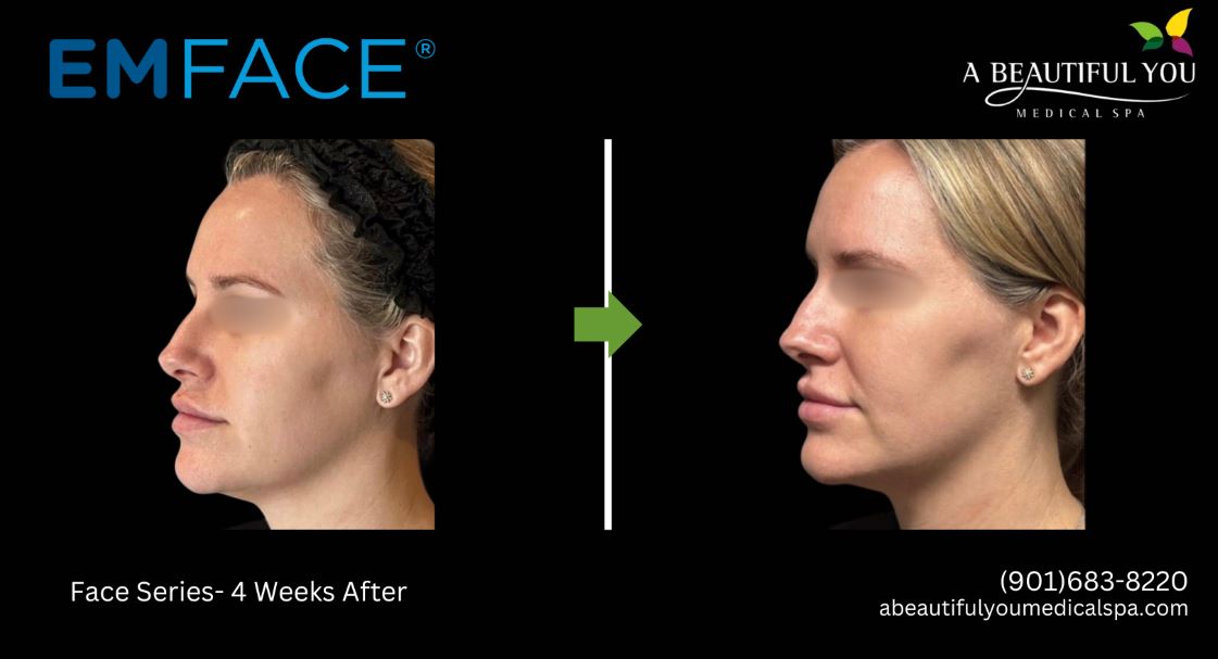 A Beautiful You Medical Spa EMFACE Lift