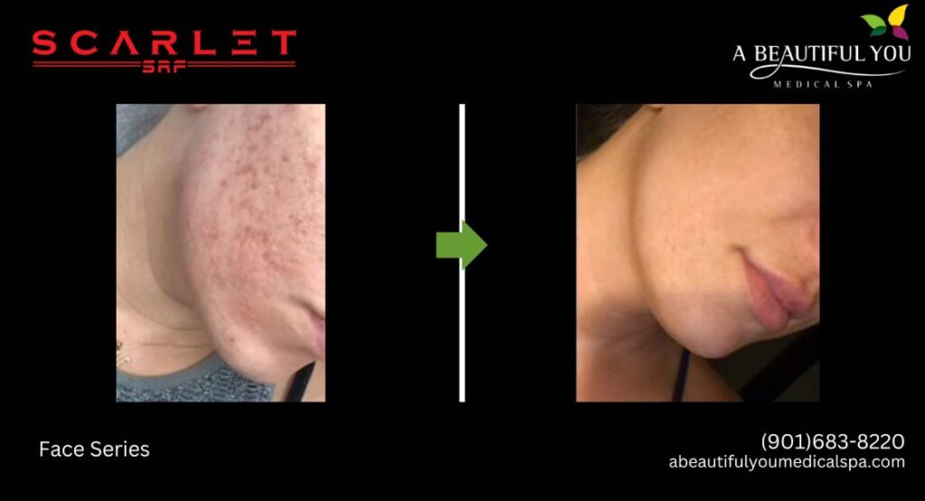 Microneedling A Beautiful You Medical Spa