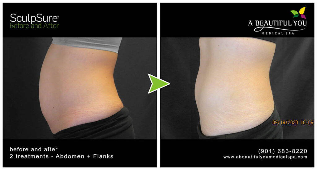 A Beautiful You Medical Spa SculpSure Body Contouring