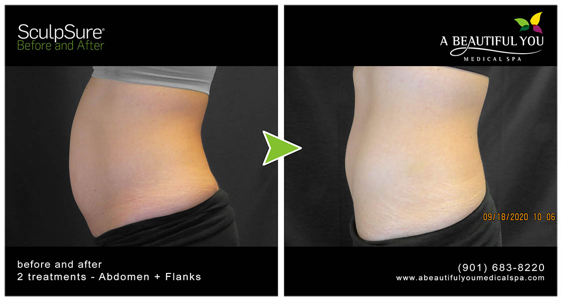 SculpSure 3 - A Beautiful You Medical Spa