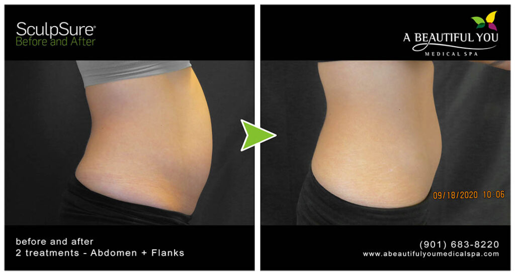 A Beautiful You Medical Spa SculpSure Body Contouring
