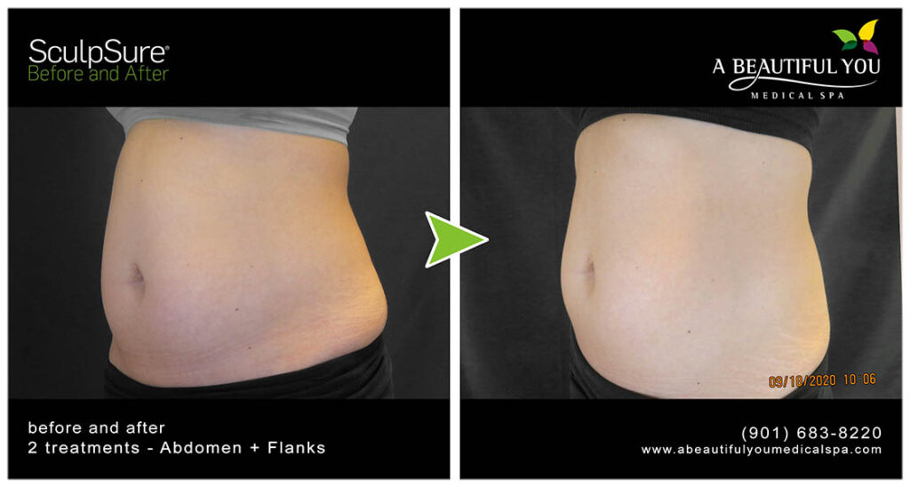 A Beautiful You Medical Spa SculpSure Body Contouring