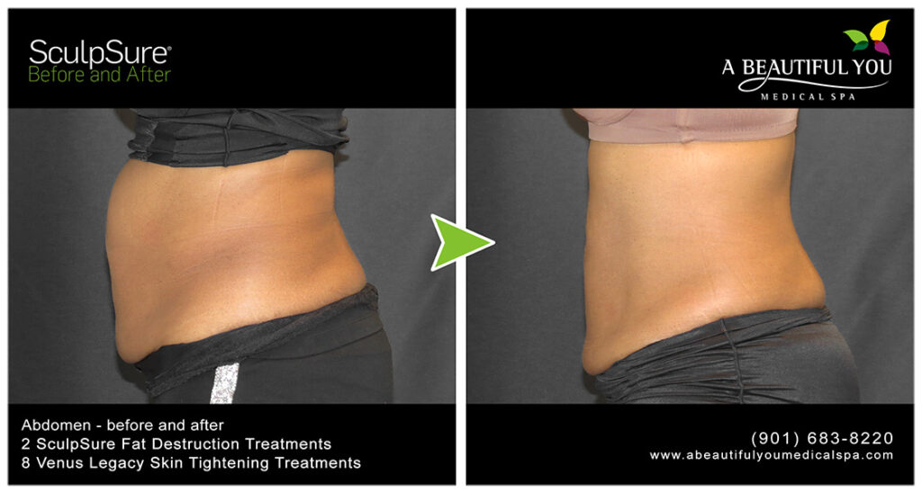 A Beautiful You Medical Spa SculpSure Body Contouring