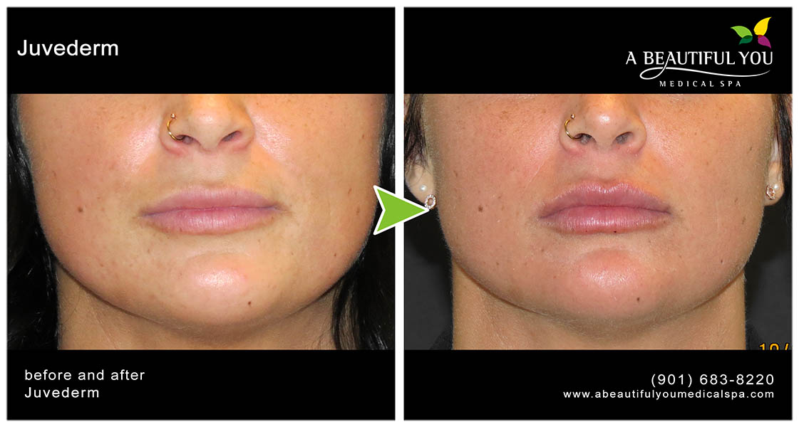 Injectables, Filler Lips