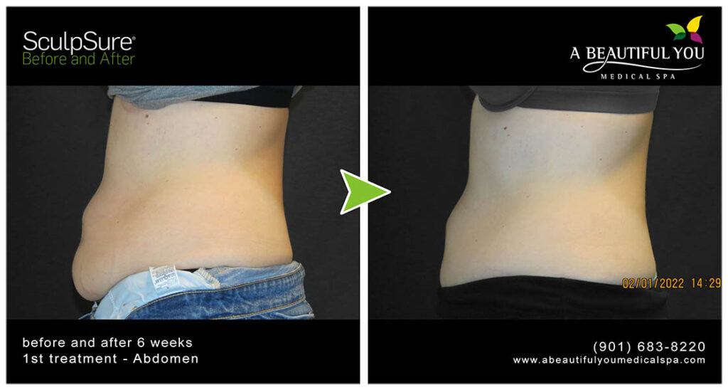 SculpSure Body Contouring A Beautiful You Medical Spa