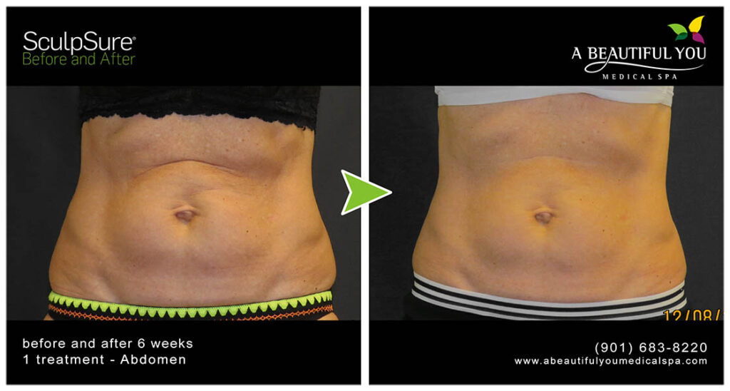 A Beautiful You Medical Spa SculpSure Body Contouring