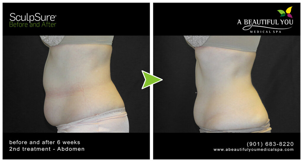 A Beautiful You Medical Spa SculpSure Body Contouring