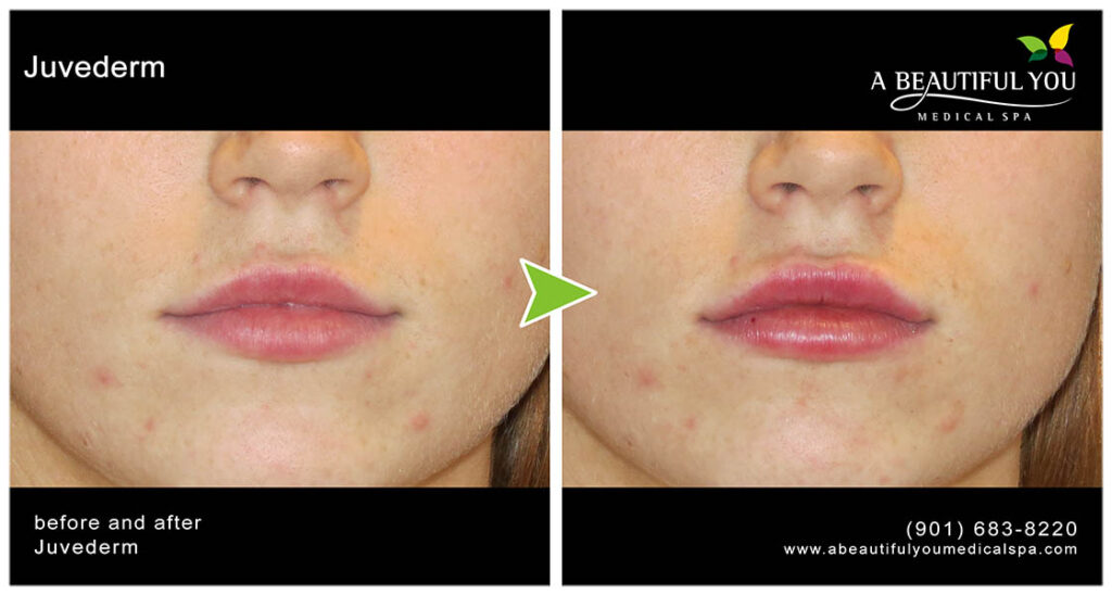 Injectables, Filler Lips