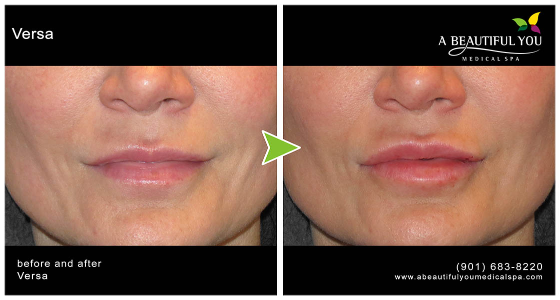 Injectables, Filler Lips