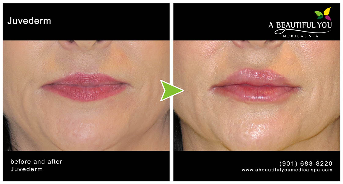 Injectables, Filler Lips