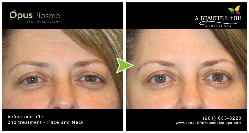 Opus Plasma A Beautiful You Medical Spa