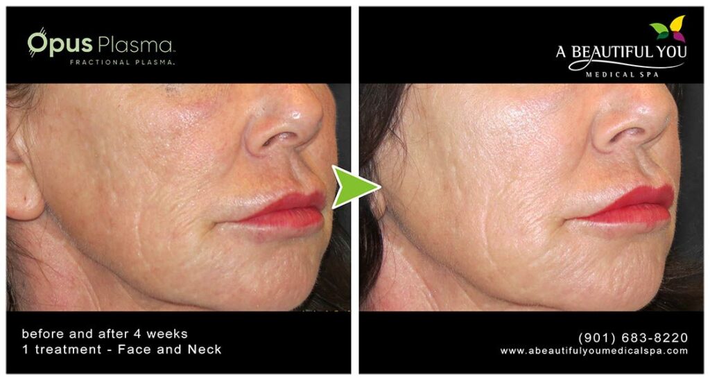 Opus Plasma A Beautiful You Medical Spa