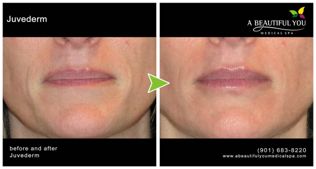 Injectables, Filler Lips