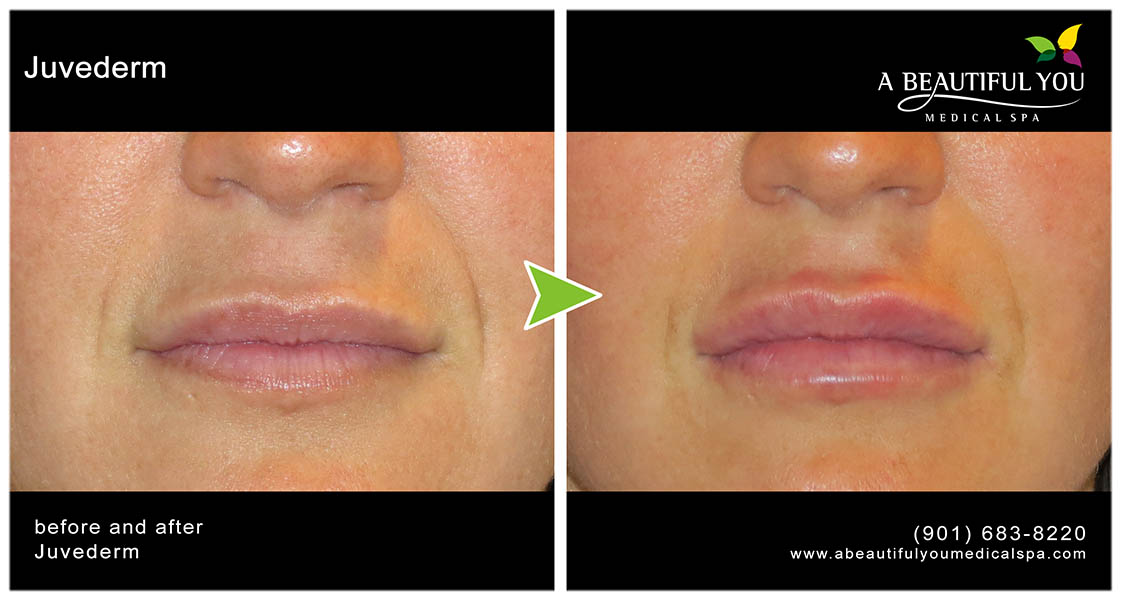 Injectables, Filler Lips