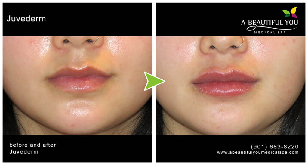 Injectables, Filler Lips