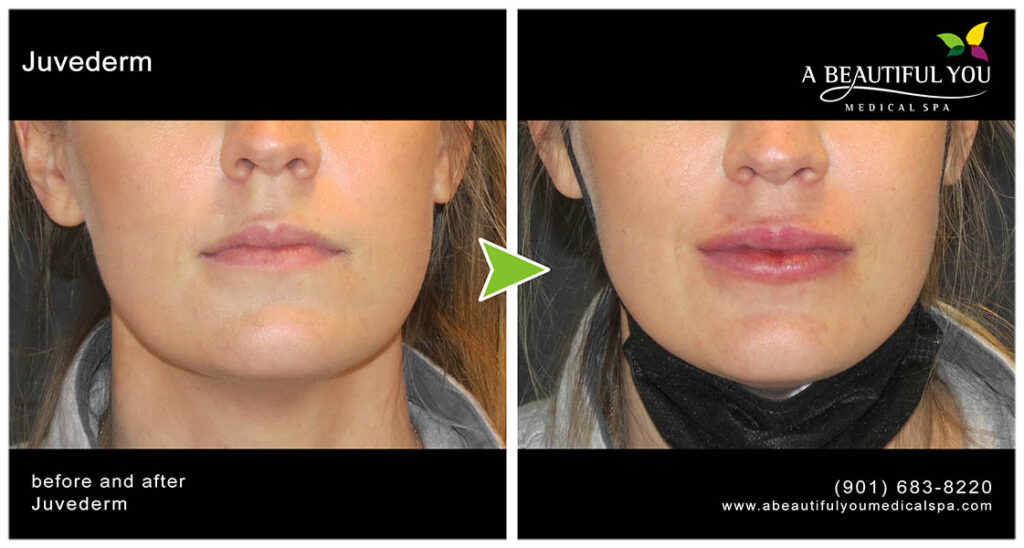 Injectables, Filler Lips
