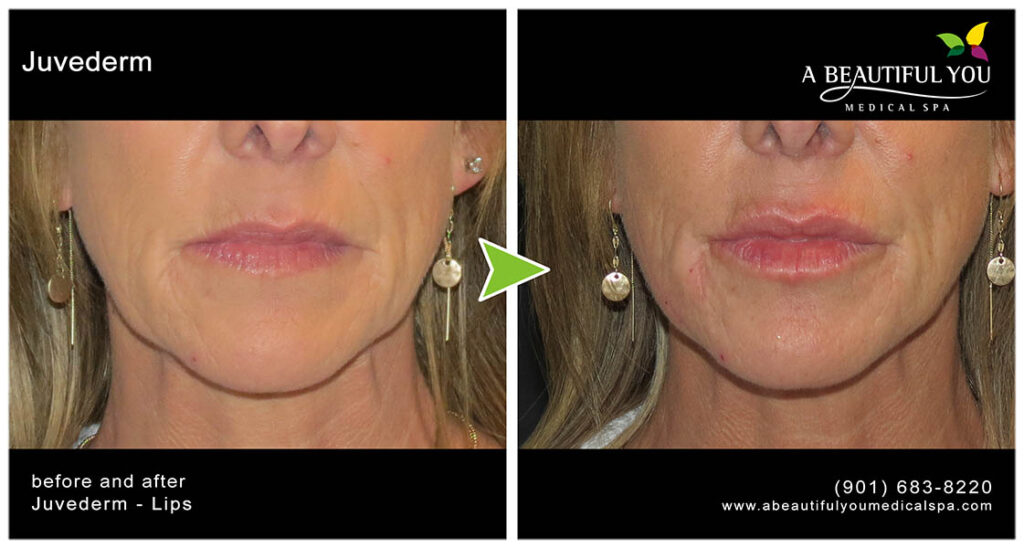 Injectables, Filler Lips