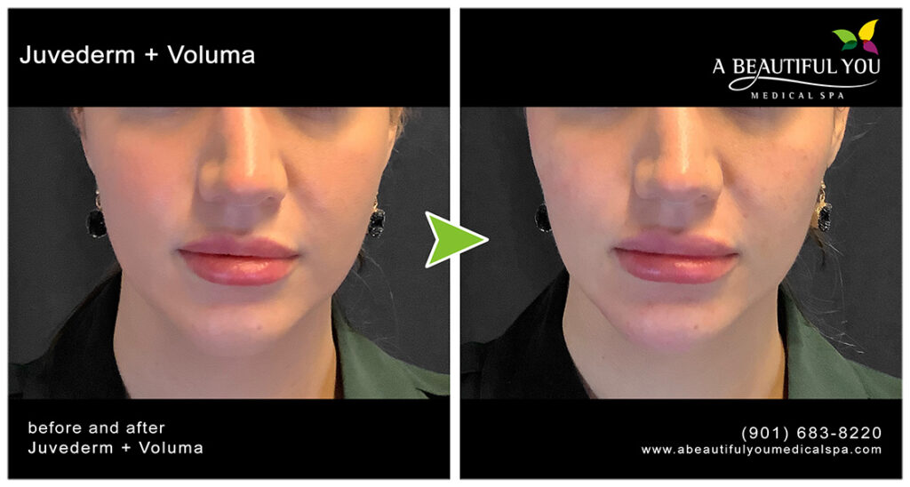 Injectables, Filler Lips