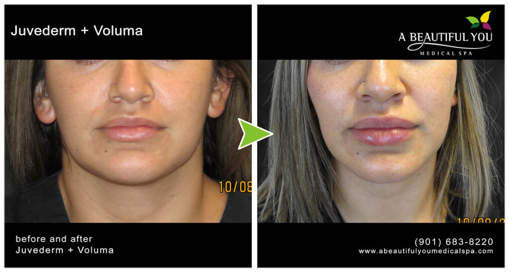 Injectables, Filler Lips