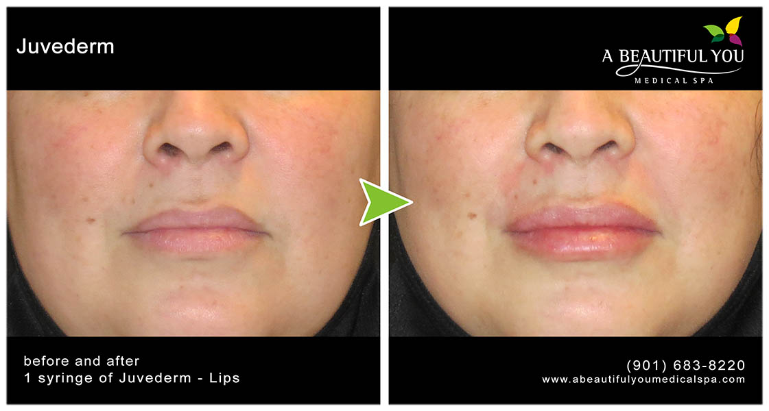 Injectables, Filler Lips
