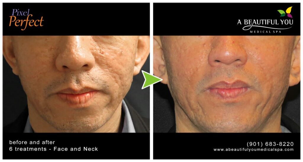 Pixel Skin Resurfacing A Beautiful You Medical Spa