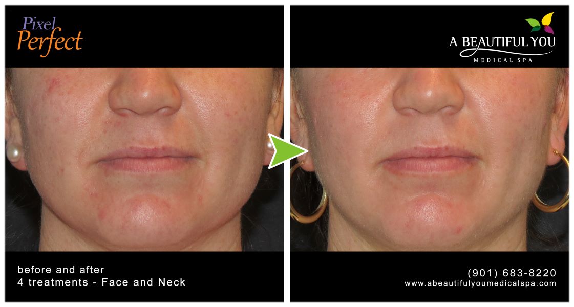 Alma Pixel Skin Resurfacing results from A Beautiful You Medical Spa in Memphis