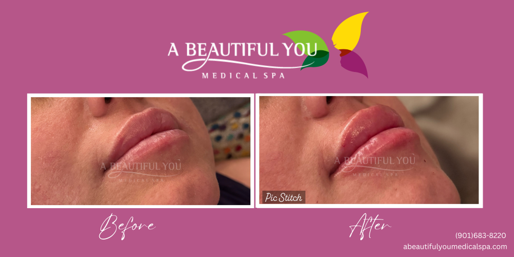 Lip Filler A Beautiful You Medical Spa